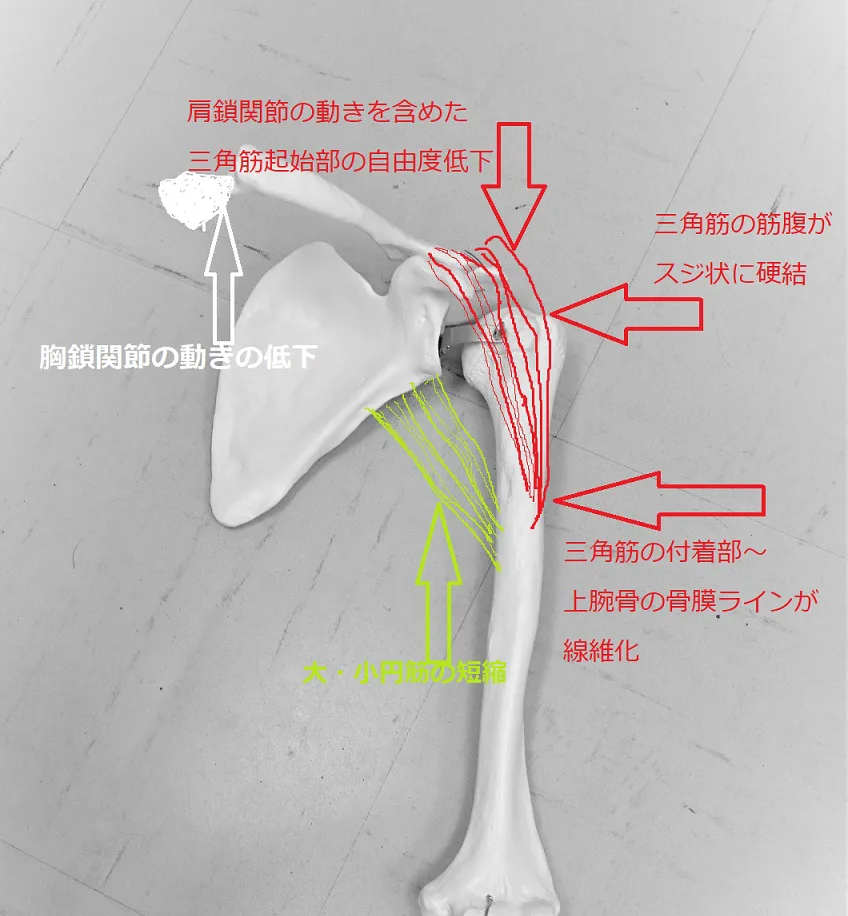 模型による50肩の筋肉の状態の解説
